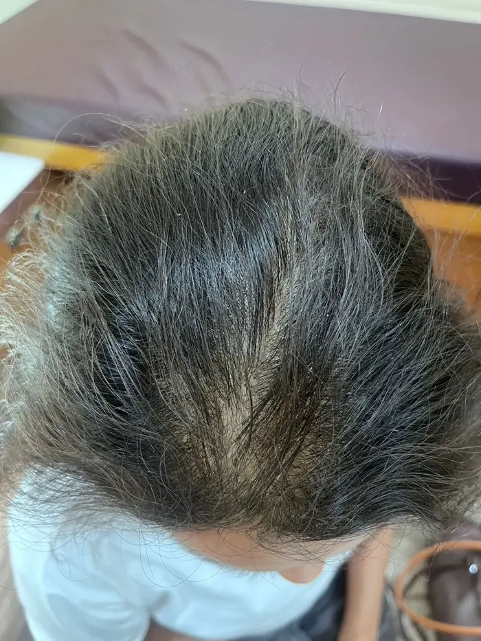 Female Pattern Baldness case 4 after treatment
